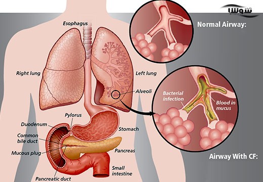 فیبروز سیستیک (Cystic Fibrosis)