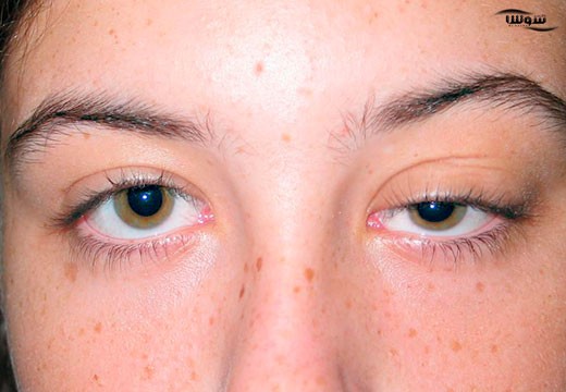 میاستنی گراویس (Myasthenia gravis)
