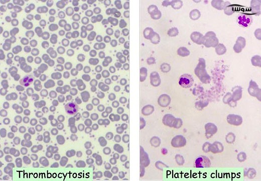 ترومبوسیتوز (Thrombocytosis)
