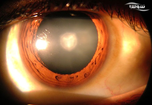 آب مروارید یا کاتاراکت (cataract)