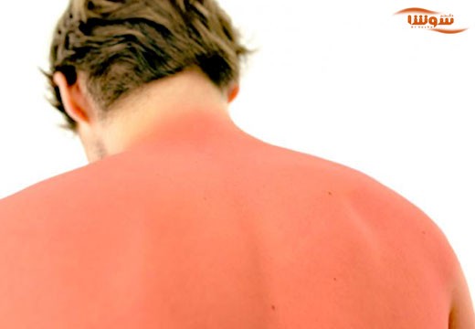 آفتاب سوختگی (sunburn)