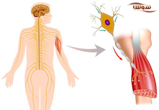 ALS | اسکلروزیس آمیوتروفیک جانبی | Amyotrophic lateral sclerosis