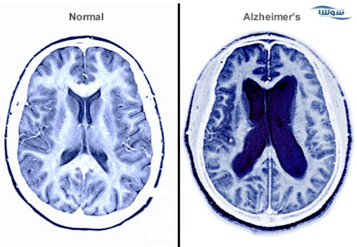 آلزایمر (Alzheimer)
