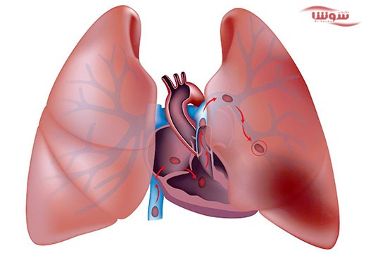 آمبولی ریه (pulmonary embolism)