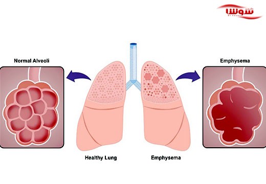 آمفیزم (Emphysema)