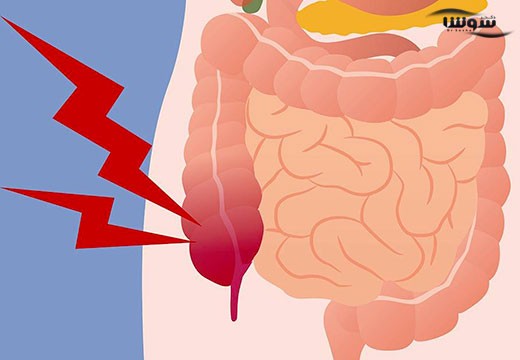 آپاندیسیت (Appendicitis)