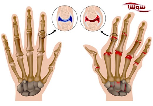 آرتریت روماتوئید (Rheumatoid arthritis)