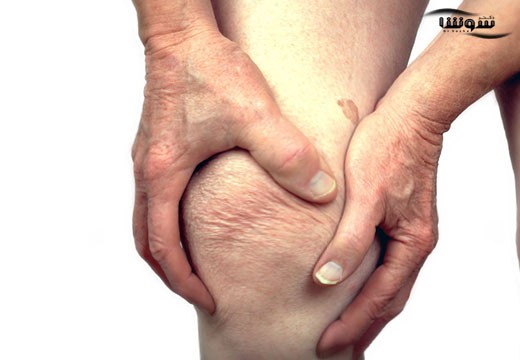 آرتریت عفونی یا آرتریت سپتیک (Septic arthritis)