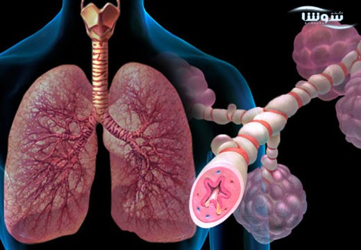 آسم (Asthma)
