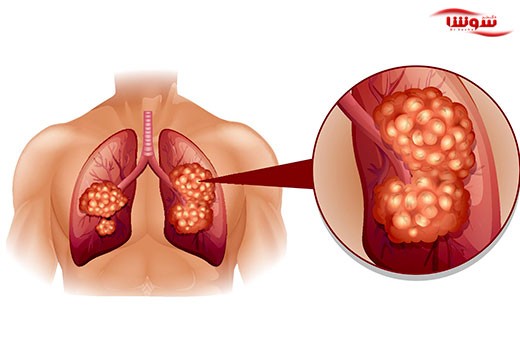 آزبستوز (Asbestosis)