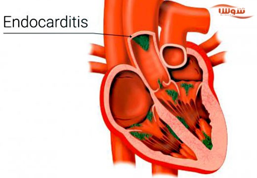 اندوکاردیت باکتریایی (Endocarditis)