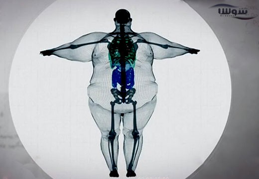 چاقی (Obesity)