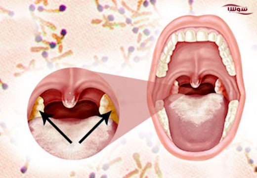 دیفتری (Diphtheria)