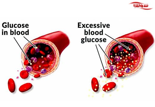 دیابت نوع 2 (type 2 diabetes)