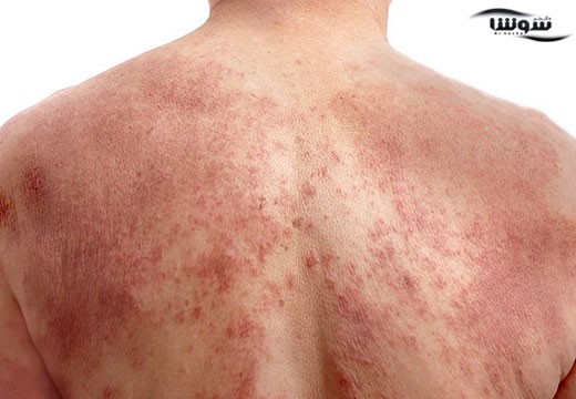 اگزما (Eczema)