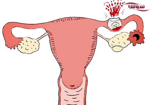 حاملگی خارج رحمی (Ectopic pregnancy)