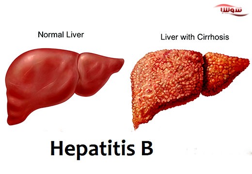 هپاتیت Hepatitis B | B