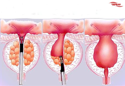 هایپرپلازی خوش خیم پروستات (Benign prostatic hyperplasia)