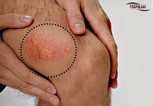 کهیر (Hives and angioedema)