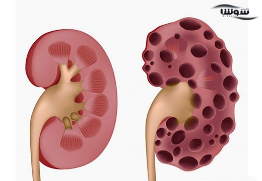 کیست کلیه (kidney cysts)