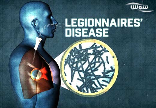 لژیونر (Legionnaires’ disease)
