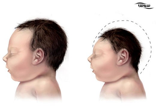 میکروسفالی | کوچک بودن سر (Microcephaly)