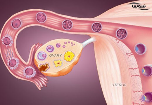 ناباروری زنان (women infertility)