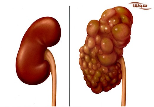 نارسایی مزمن کلیوی (Chronic renal failure)