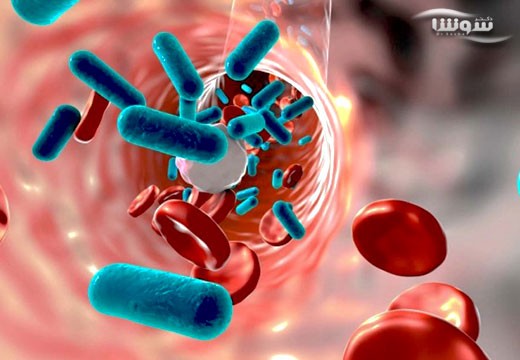 سپتی سمی یا عفونت خون (Sepsis)