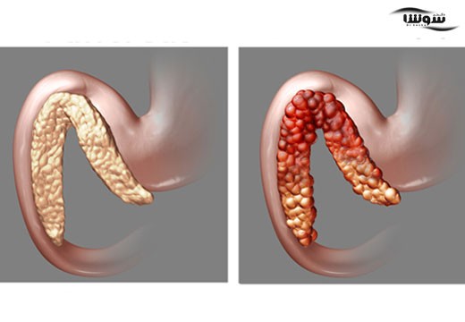 پانکراتیت (pancreatitis)
