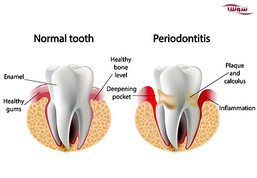 پریودنتیت (periodontitis)