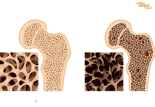 پوکی استخوان | استئوپروز (Osteoporosis)