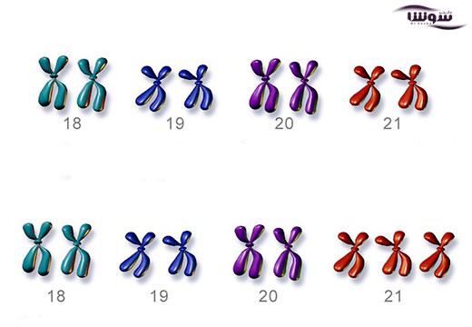 سندرم داون (Down syndrome)