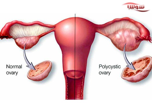 سندروم تخمدان پلی کیستیک (Polycystic ovary syndrome)