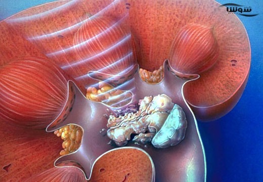 سنگ کلیه (kidney stone)