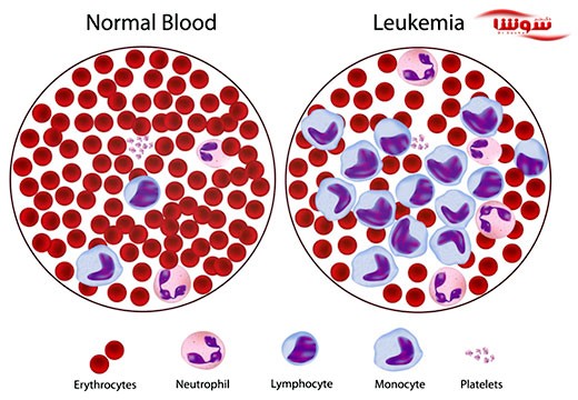 سرطان خون | لوکمی | لوسمی (Leukemia)