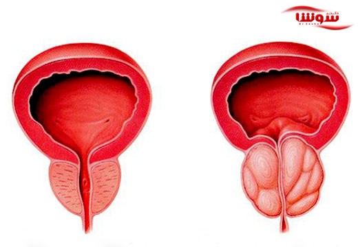 سرطان پروستات (Prostate cancer)