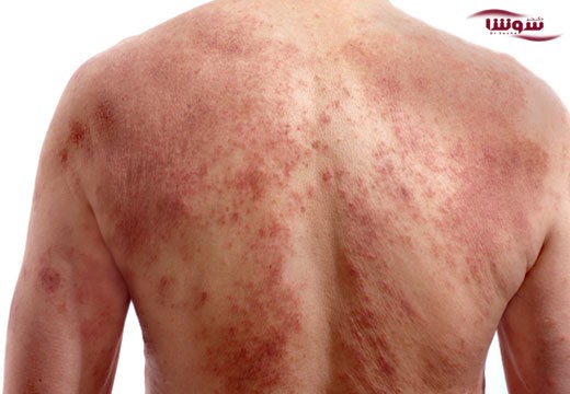 سرطان پوست (skin cancer)