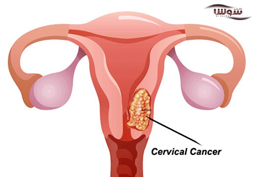 سرطان رحم (cervical cancer)