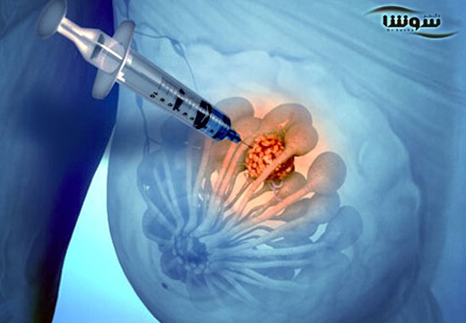 سرطان سینه (Breast cancer)