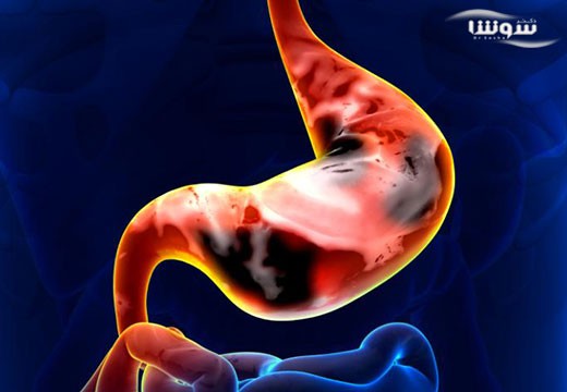 سرطان معده (Stomach cancer)