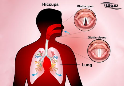 سکسکه (hiccups)