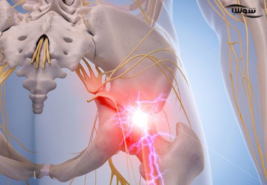 سیاتیک (sciatica)