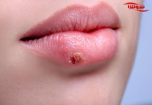 تب خال (Cold sore)