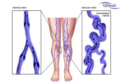 واریس (varicose-veins)