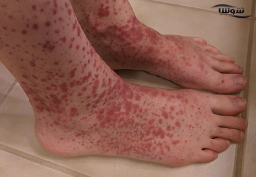 واسکولیت (Vasculitis)