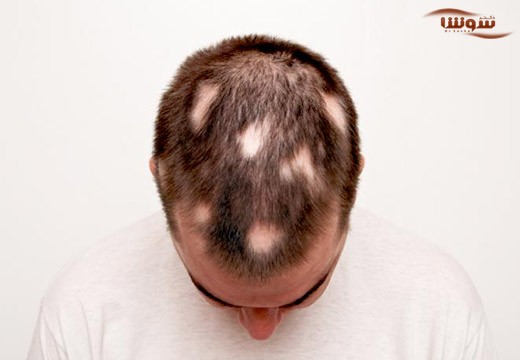 آلوپسی آره آتا ( Areata Alopecia )