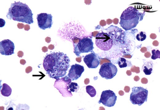 هیستوپلاسموزیس (Histoplasmosis)