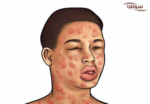 آنافیلاکسی (anaphylaxis)