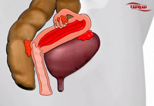 اندومتریوز (endometriosis)